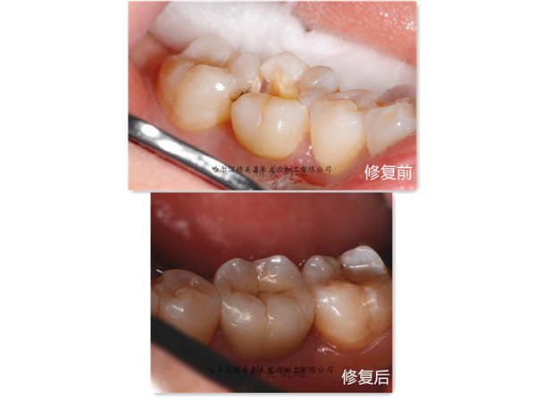 二氧化锆全瓷修复体